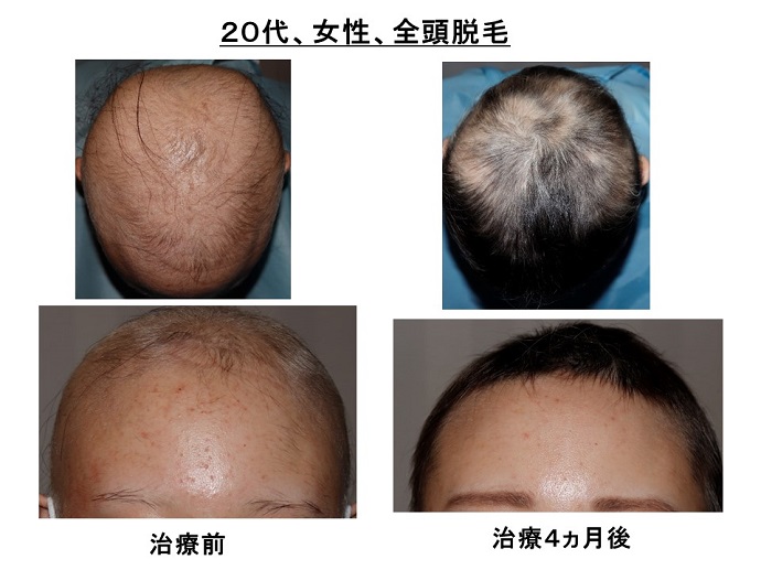 円形脱毛症　病院